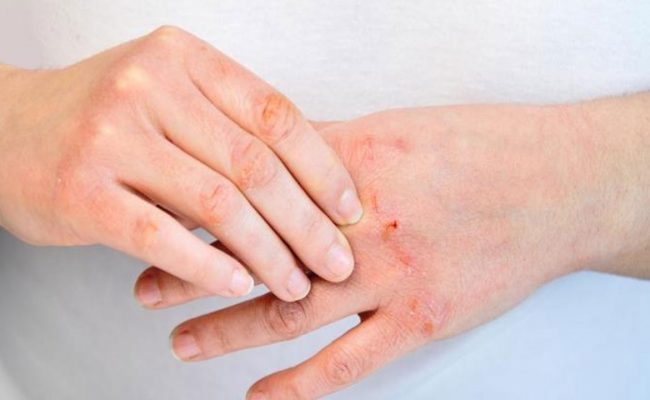 «استشاري جلدية» يكشف أشهر 7 أسباب لتهيج الصدفية