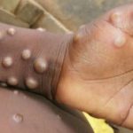 يشمل «القرود والبقر».. استشاري أمراض باطنية يكشف عن عائلة فيروسات «الجدري»